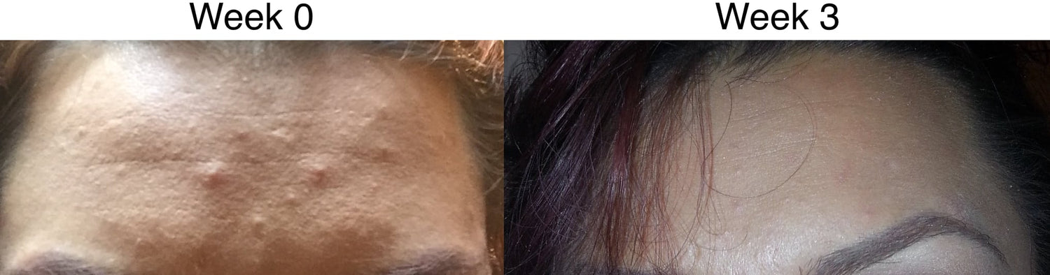 Clear Acne in 2 Days: 10 New Methods | Champïone