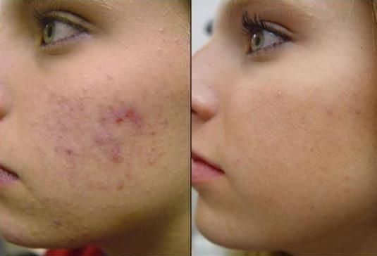 Skin Picking: Fast Pimple Cover-Up & Healing | Champïone Tips